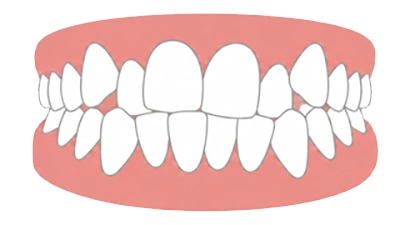 Encombrement dentaire (Chevauchement)